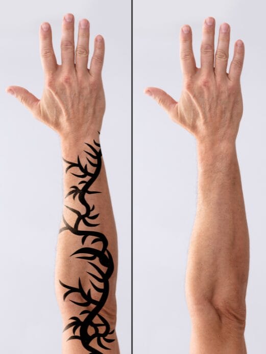 Antes y después de la eliminación de un tatuaje en el brazo