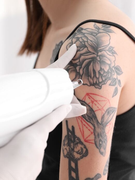 Cuello de mujer con tatuaje y unas marcas que muestran las diferentes etapas de la eliminación de un tatuaje
