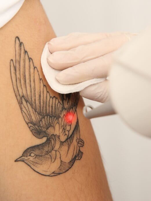 Mujer de espalda mostrando su hombro de mujer con tatuaje y unas marcas que muestran las diferentes etapas de eliminación de tatuajes con láser
