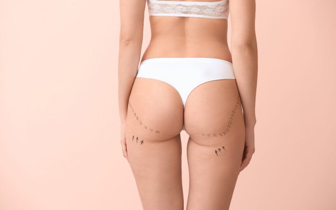 Tratamiento para mejorar la forma de los glúteos sin cirugía en Miami