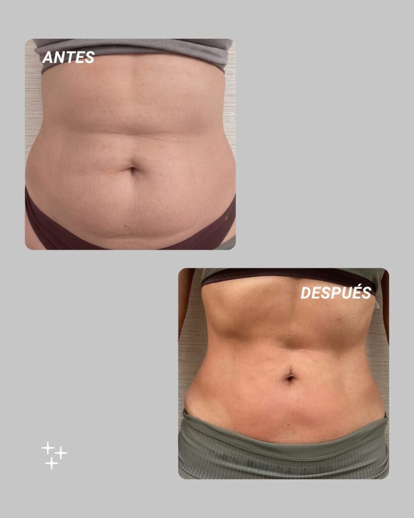 Resultado de definición y retracción cutánea con Endoláser antes y después