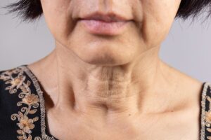 flacidez facial tratamiento Miami